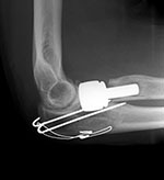 Radial head prosthesis